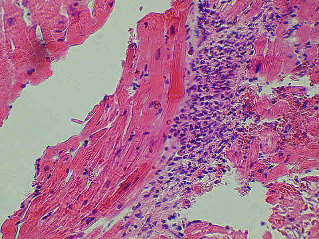 Naciek zapalny z granulocytów obojętnochłonnych niszczący przyległe kardiomiocyty